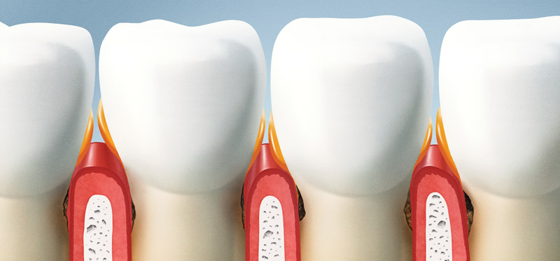 periodontal treatment